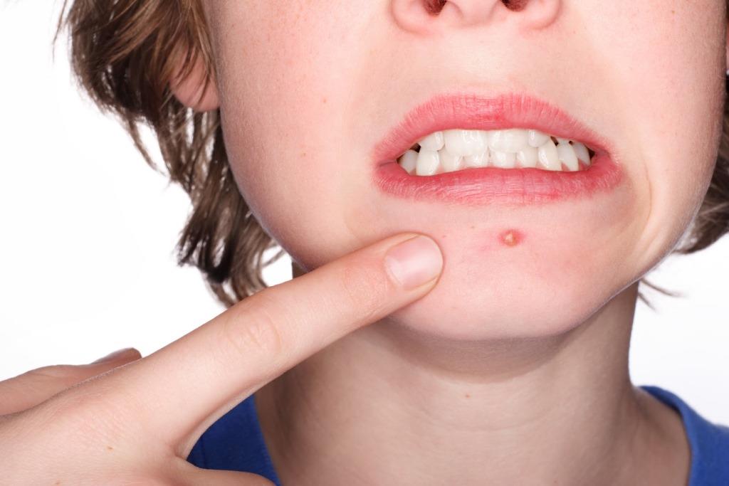 Resultado de imagen para acne en adolescentes
